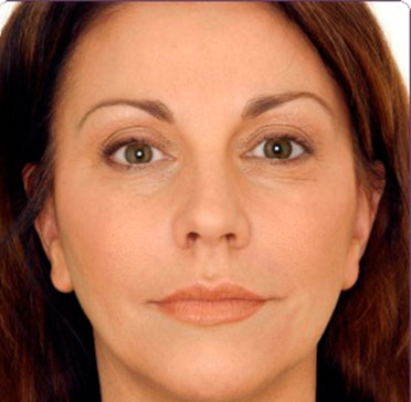 juvederm-2-after