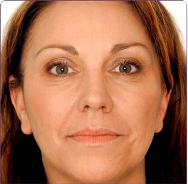 juvederm-2-before