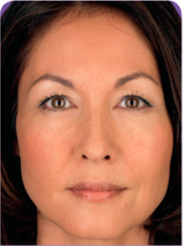 juvederm-3-before